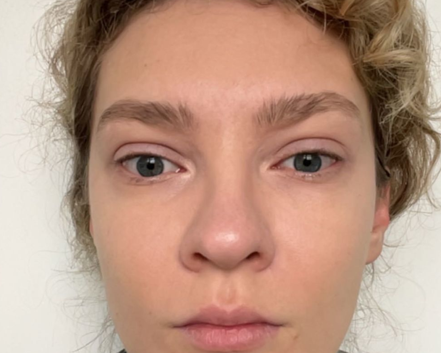 Eunice - Cheeks - After