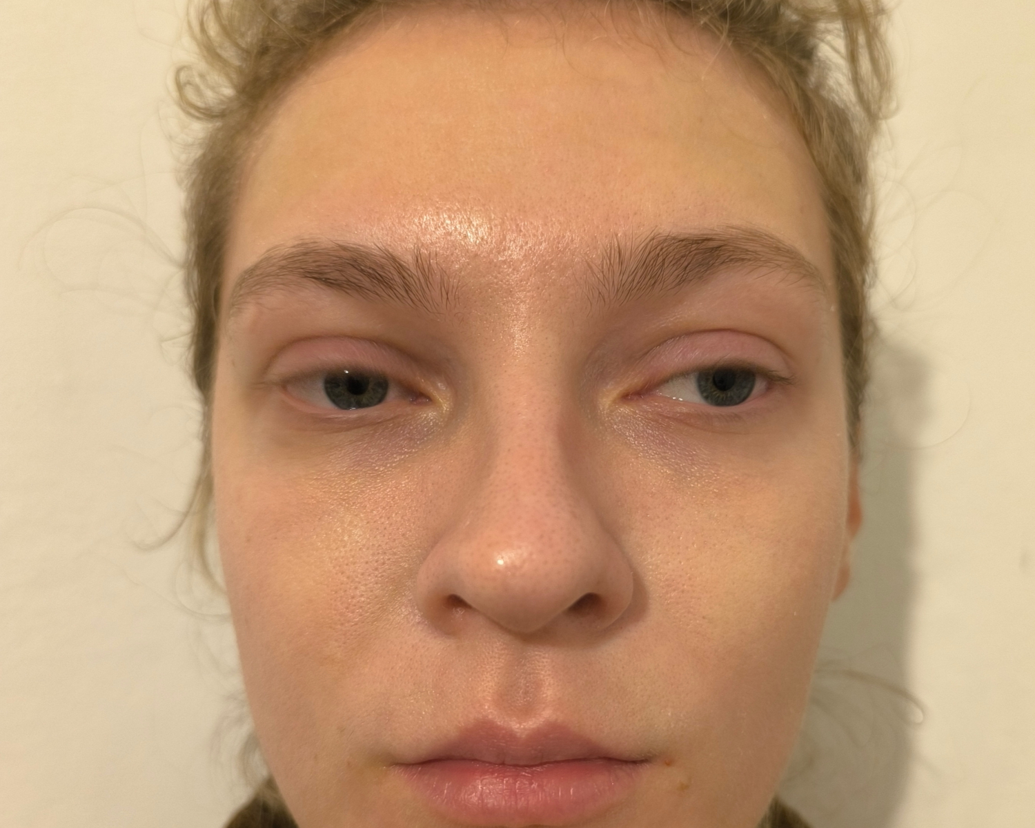 Eunice - Cheeks - Before