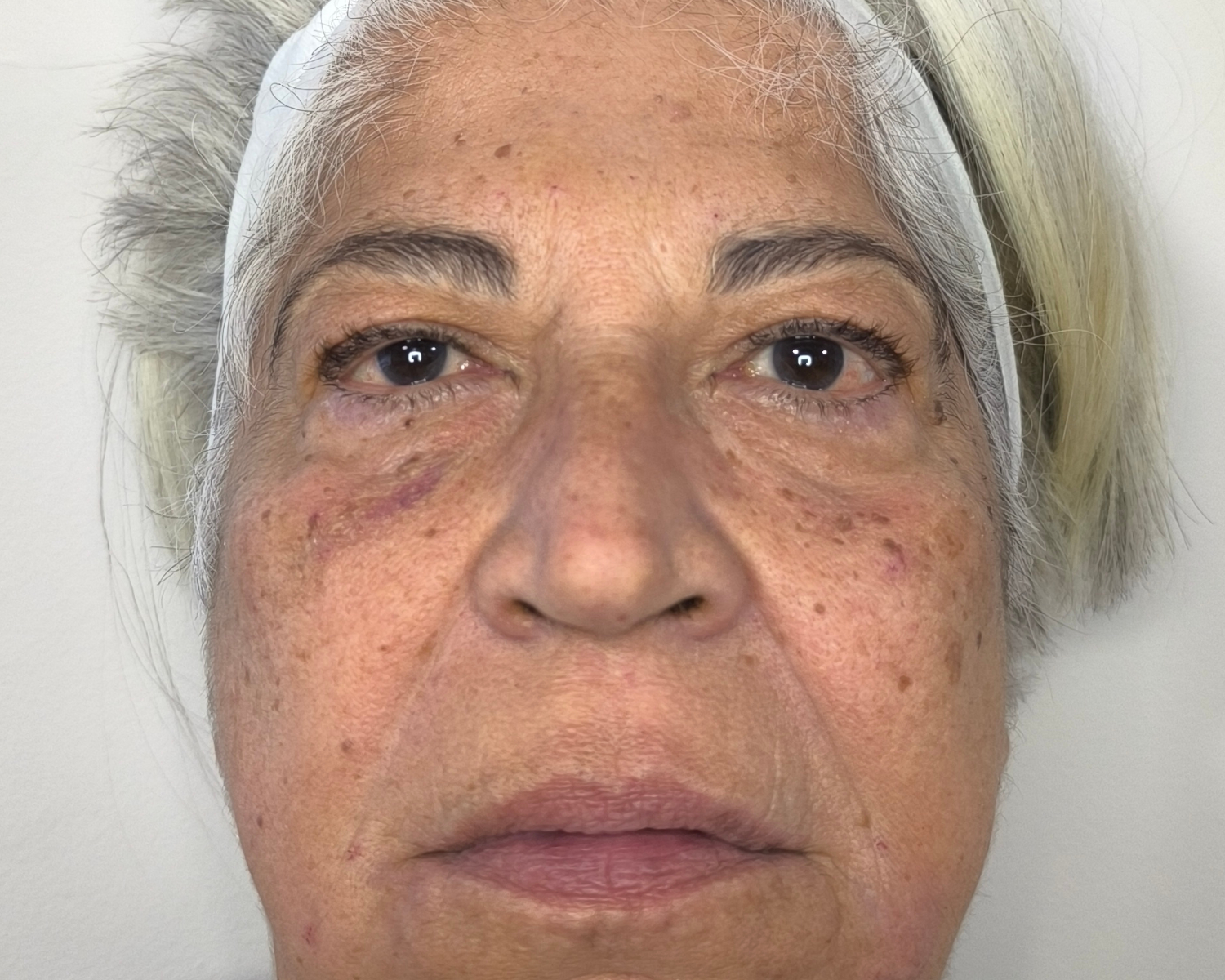 Mom - Fillers after-1