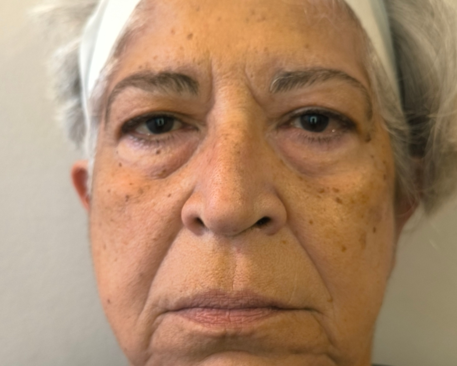 Mom - Fillers before-1